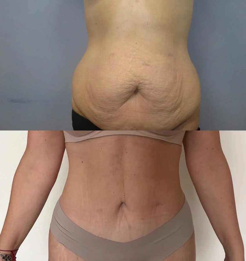 Tummy Tuck before and after, front view