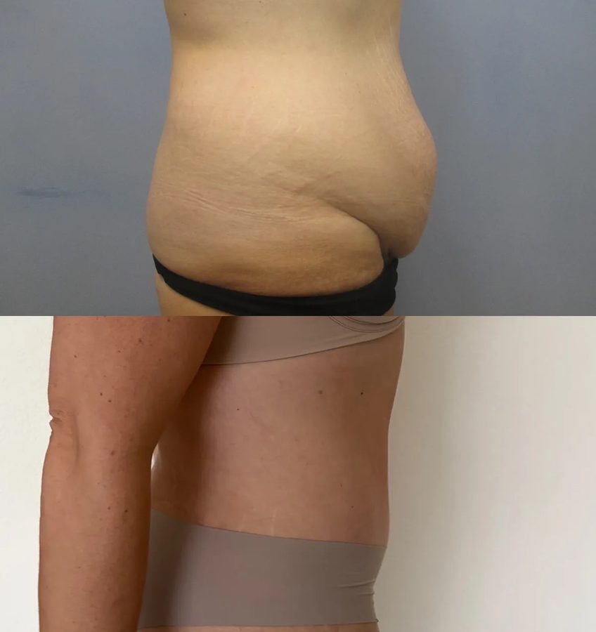 Tummy Tuck before and after, side view
