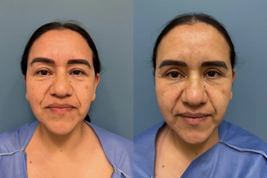 Facial Rejuvenation before and after, front view