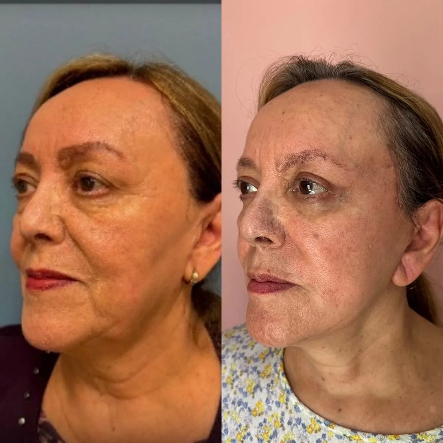 Facelift before and after, three-quarter view