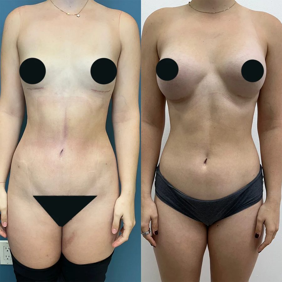 Breast Augmentation before and after, front view