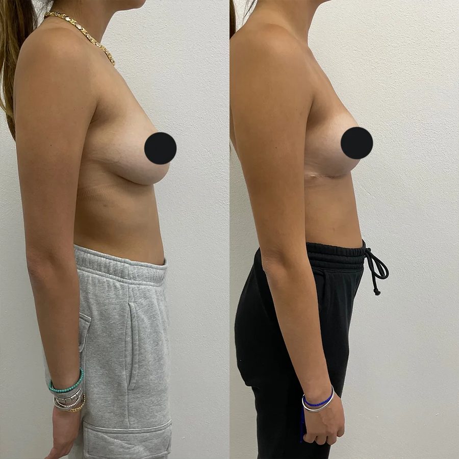 Breast Augmentation before and after, profile view