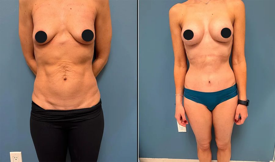 Mommy Makeover before and after, breast & abdomen