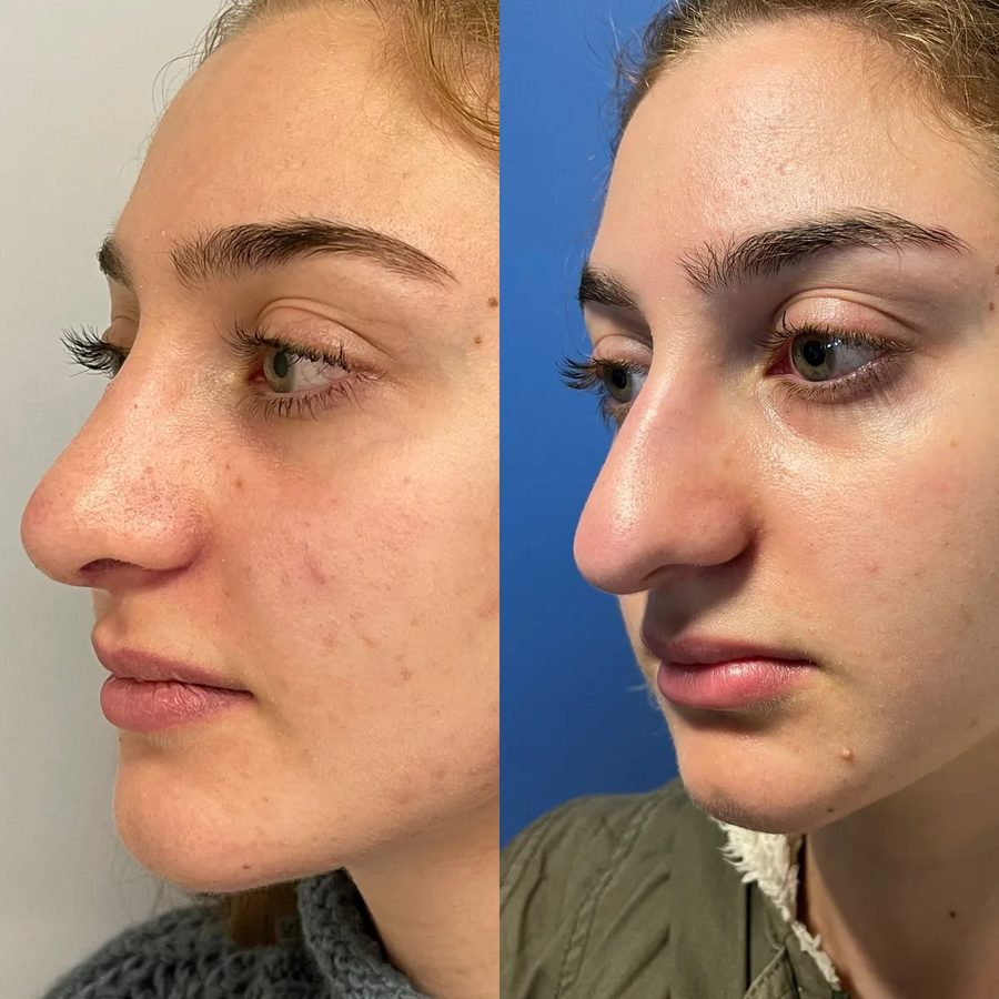 Rhinoplasty before and after, three-quarter view